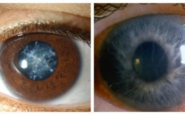 Чем отличаются катаракта и глаукома? — Читать подробнее на нашем сайте. Офтальмологическая клиника «Сфера»